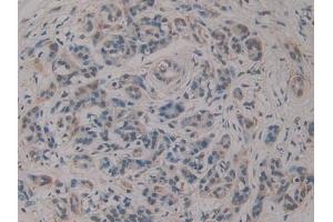 Detection of RSPO3 in Human Pancreatic cancer Tissue using Polyclonal Antibody to R-Spondin 3 (RSPO3)