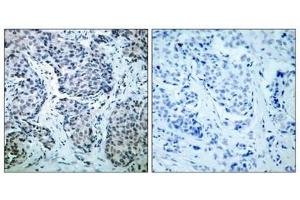 Immunohistochemical analysis of paraffin-embedded human breast carcinoma tissue using SEK1/MKK4(Phospho-Thr261) Antibody(left) or the same antibody preincubated with blocking peptide(right). (MAP2K4 anticorps  (pThr261))