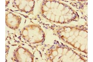 Immunohistochemistry of paraffin-embedded human colon cancer using ABIN7154300 at dilution of 1:100