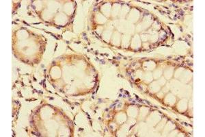 Immunohistochemistry of paraffin-embedded human colon cancer using ABIN7154300 at dilution of 1:100 (GOLPH3L anticorps  (AA 6-285))