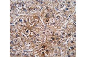 IHC analysis of FFPE human hepatocarcinoma tissue stained with BMPR2 antibody