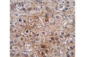 IHC analysis of FFPE human hepatocarcinoma tissue stained with BMPR2 antibody (BMPR2 anticorps  (AA 28-59))