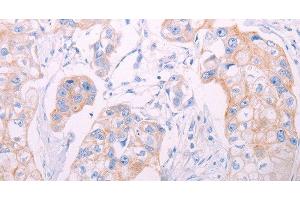 Immunohistochemistry of paraffin-embedded Human breast cancer tissue using ADAMTS14 Polyclonal Antibody at dilution 1:50 (ADAMTS14 anticorps)