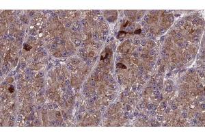 ABIN6273987 at 1/100 staining Human liver cancer tissue by IHC-P.