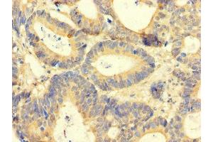 Immunohistochemistry of paraffin-embedded human colon cancer using ABIN7144028 at dilution of 1:100 (Amphiregulin anticorps  (AA 107-148))