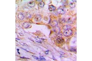 Immunohistochemical analysis of Caspase 6 p18 staining in human lung cancer formalin fixed paraffin embedded tissue section. (Caspase 6 p18 (Center) anticorps)
