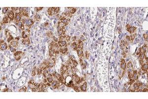 ABIN6278946 at 1/100 staining Human liver cancer tissue by IHC-P.