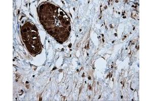 Immunohistochemical staining of paraffin-embedded Adenocarcinoma of colon tissue using anti-ACLY mouse monoclonal antibody. (ACLY anticorps)