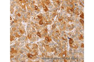 Immunohistochemistry of Human liver cancer using MCM5 Polyclonal Antibody at dilution of 1:40 (MCM5 anticorps)