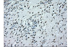 Immunohistochemical staining of paraffin-embedded Adenocarcinoma of breast tissue using anti-BRAF mouse monoclonal antibody. (BRAF anticorps)