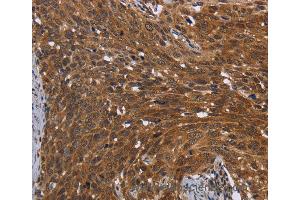 Immunohistochemistry of Human cervical cancer using FHIT Polyclonal Antibody at dilution of 1:30