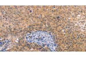 Immunohistochemistry of paraffin-embedded Human cervical cancer tissue using pVHL Polyclonal Antibody at dilution 1:40 (VHL anticorps)
