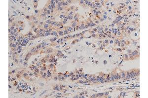 ABIN6268640 at 1/50 staining human colon cancer tissue sections by IHC-P.