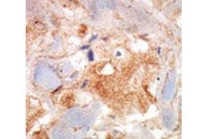 cKit antibody was used in immunohistochemistry on breast carcinoma. (KIT anticorps  (AA 9-40))