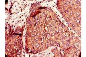 Immunohistochemistry of paraffin-embedded human ovarian cancer using ABIN7170088 at dilution of 1:100