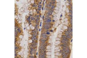 Immunohistochemistry of paraffin-embedded human rectal cancer using MMP25 antibody (ABIN5971552) at dilution of 1/200 (40x lens). (MMP25 anticorps)