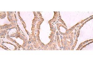 Immunohistochemistry of paraffin-embedded Human thyroid cancer tissue using EEF1D Polyclonal Antibody at dilution of 1:65(x200)