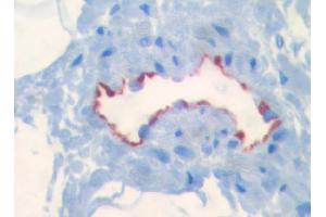 Immunohistochemical staining on paraffin sections of human intestine (border area of a colon carcinoma) using LYVE-1 antibody #ABIN115663 (picture courtesy of Dr. (LYVE1 anticorps  (AA 24-231))