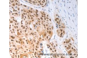 Immunohistochemistry of Human esophagus cancer using SLC22A8 Polyclonal Antibody at dilution of 1:70