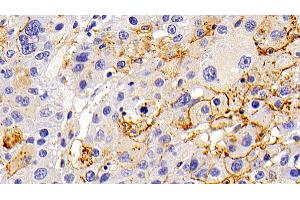 Detection of LAMP1 in Human Liver cancer Tissue using Polyclonal Antibody to Lysosomal Associated Membrane Protein 1 (LAMP1)