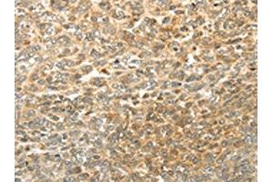 The image on the left is immunohistochemistry of paraffin-embedded Human ovarian cancer tissue using ABIN7130225(MGEA5 Antibody) at dilution 1/20, on the right is treated with fusion protein. (MGEA5 anticorps)