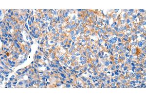 Immunohistochemistry of paraffin-embedded Human breast cancer tissue using HCN2 Polyclonal Antibody at dilution 1:80
