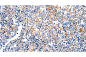 Immunohistochemistry of paraffin-embedded Human breast cancer tissue using HCN2 Polyclonal Antibody at dilution 1:80 (HCN2 anticorps)