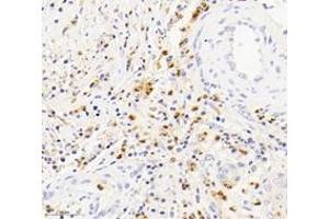 Immunohistochemistry analysis of paraffin-embedded human squamous carcinoma of the cervix using S100A12 (ABIN7075493) at dilution of 1: 4000 (S100A12 anticorps)