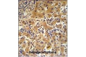 CP Antibody (N-term) (ABIN391512 and ABIN2841473) IHC analysis in formalin fixed and paraffin embedded human hepatocarcinoma followed by peroxidase conjugation of the secondary antibody and DAB staining.