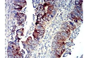 Immunohistochemical analysis of paraffin-embedded rectum cancer tissues using P2RY14 mouse mAb with DAB staining.