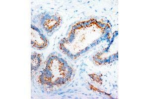 Anti-CXCR4 antibody, IHC(P) IHC(P): Human Mammary Cancer Tissue (CXCR4 anticorps  (N-Term))
