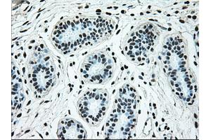 Immunohistochemical staining of paraffin-embedded breast tissue using anti-BRAF mouse monoclonal antibody. (BRAF anticorps)