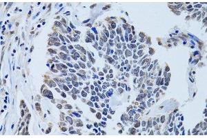 Immunohistochemistry of paraffin-embedded Human lung cancer using SIN3A Polyclonal Antibody at dilution of 1:100 (40x lens).