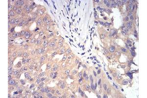 0:Immunohistochemical analysis of paraffin-embedded ovarian cancer tissues using DDX3X mouse mAb with DAB staining.