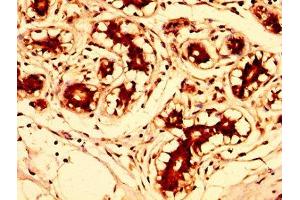 IHC image of ABIN7143738 diluted at 1:300 and staining in paraffin-embedded human breast cancer performed on a Leica BondTM system.