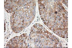 Immunohistochemical staining of paraffin-embedded Adenocarcinoma of Human breast tissue using anti-TUBB4 mouse monoclonal antibody. (TUBB4 anticorps)