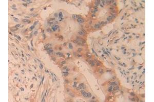 Detection of PKLR in Human Bile duct cancer Tissue using Polyclonal Antibody to Pyruvate kinase isozymes R/L (PKLR)