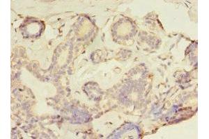 Immunohistochemistry of paraffin-embedded human breast cancer using ABIN7153932 at dilution of 1:100 (GFOD2 anticorps  (AA 1-280))