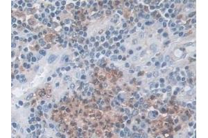 Detection of TPP1 in Human Colorectal cancer Tissue using Polyclonal Antibody to Tripeptidyl Peptidase I (TPP1)