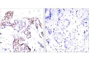 Immunohistochemical analysis of paraffin-embedded human breast carcinoma tissue using Elk-1 (phospho-Ser389) antibody (E011037). (ELK1 anticorps  (pSer389))