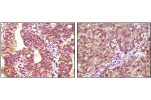 Immunohistochemical analysis of paraffin-embedded human bladder carcinoma tissue(left) and lung carcinoma tissue (right) showing cytoplasmic localization using BRAF antibody with DAB staining. (BRAF anticorps)