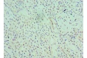 Immunohistochemistry of paraffin-embedded human breast cancer using ABIN7168966 at dilution of 1:100 (SRSF1 anticorps  (AA 1-248))