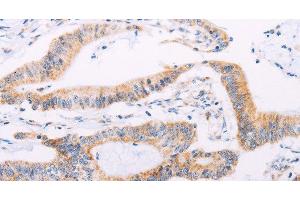 Immunohistochemistry of paraffin-embedded Human colon cancer tissue using ADAMTS16 Polyclonal Antibody at dilution 1:50 (ADAMTS16 anticorps)