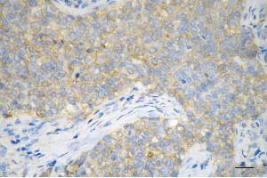 Immunohistochemistry was performed on paraffin-embedded human breast carcinoma using ATP6V1A antibody (ABIN7797699), 1:200).