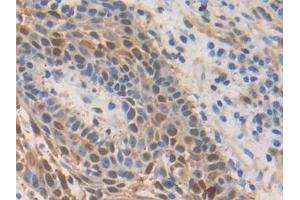 Detection of S100A2 in Human Skin cancer Tissue using Polyclonal Antibody to S100 Calcium Binding Protein A2 (S100A2)