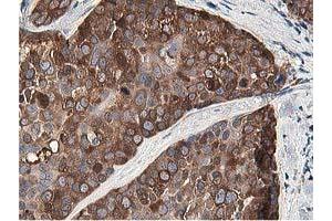 Immunohistochemical staining of paraffin-embedded Adenocarcinoma of Human breast tissue using anti-OSBP mouse monoclonal antibody. (OSBP anticorps)