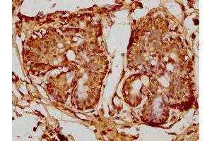 IHC image of ABIN7164990 diluted at 1:100 and staining in paraffin-embedded human breast cancer performed on a Leica BondTM system.