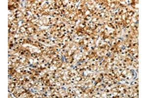 The image on the left is immunohistochemistry of paraffin-embedded Human renal cancer tissue using ABIN7190724(FZD2 Antibody) at dilution 1/25, on the right is treated with synthetic peptide. (FZD2 anticorps)