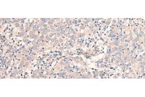 Immunohistochemistry of paraffin-embedded Human cervical cancer tissue using EMX1 Polyclonal Antibody at dilution of 1:25(x200) (EMX1 anticorps)