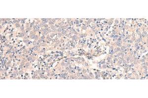 Immunohistochemistry of paraffin-embedded Human cervical cancer tissue using EMX1 Polyclonal Antibody at dilution of 1:25(x200)